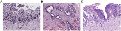 Establishment and validation of a predictive nomogram for the risk of premalignant lesions in children with choledochal cyst